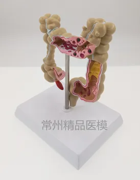 Модел патология на дебелото черво, колоректальные поражение, проба на червата, модел на обучение по анатомия на дебелото черво