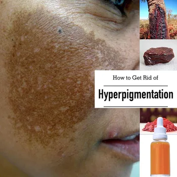 Корейски избелващ крем за лице с койевой киселина за по-тъмна кожа, Напълно выравнивающий цвета на кожата, същността на оцет за премахване на слънчеви изгаряния и пигментни петна